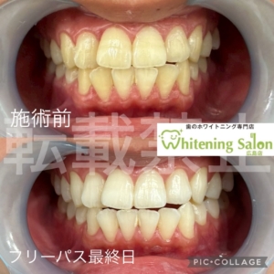 【果物と着色🍓】広島/ホワイトニング