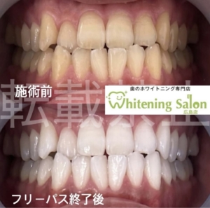 【自分に合った通い方で⭐️】広島/ホワイトニング