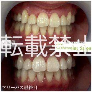 【ルミネアーズとは？】広島/ホワイトニング