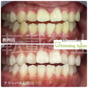 【タバコは黄ばむ？】広島/ホワイトニング