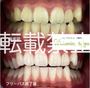 【歯のシミ】広島/ホワイトニング