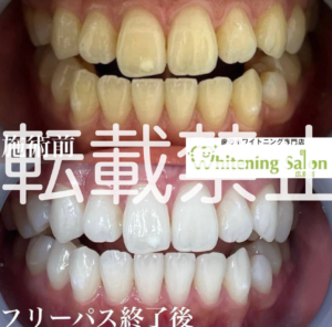 【バレンタインに向けて🎀】広島/ホワイトニング