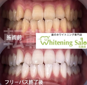 【歯が白いといいことだらけ‎🤍✨️】広島/ホワイトニング