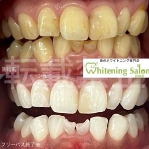 【歯と全身の深い関係👄⚡️】広島/ホワイトニング