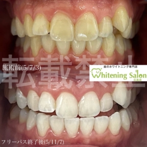 【フロスの日】広島/ホワイトニング