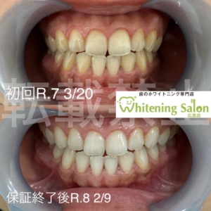 【白さキープ出来ていますか？🦷】