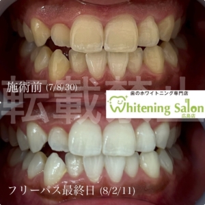 【歯磨き粉の味🎀】広島/ホワイトニング