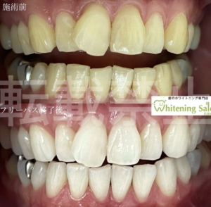 【歯がかけたら】広島/ホワイトニング