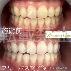 【飴と虫歯】広島/ホワイトニング