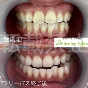 【口内炎を早く治す方法】広島/ホワイトニング