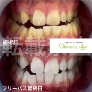 【知覚過敏の原因と対策！】広島/ホワイトニング
