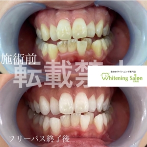 【カルシウムと歯】広島/ホワイトニング