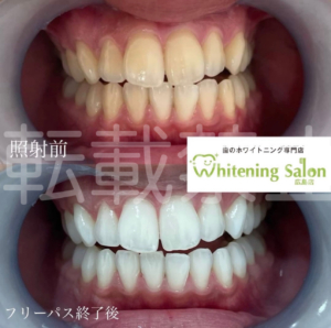 【チョコレートを楽しむには？】広島/ホワイトニング