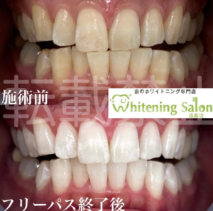【寝起きの口の中】広島/ホワイトニング