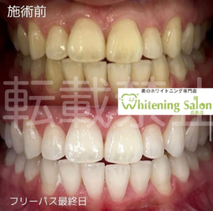 【歯は一生モノの臓器✨🦷】広島/ホワイトニング