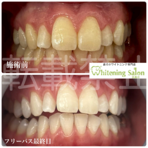【お問い合わせください⭐️】広島/ホワイトニング