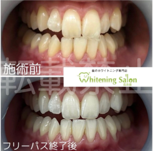 【おすすめのお茶✨】広島/ホワイトニング