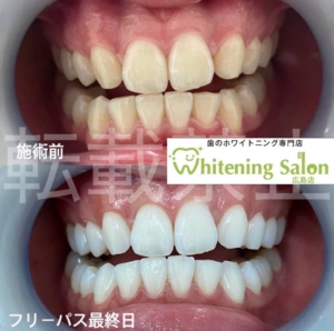 【歯、ちゃんと守れていますか？✨】広島/ホワイトニング