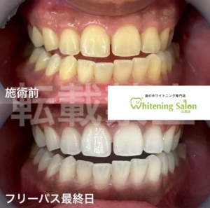 【ホワイトスポット⚡️】広島/ホワイトニング