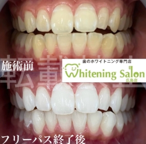 【歯ぐきの健康も大切👍🏻💖】広島/ホワイトニング