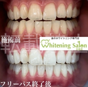 【フロスの大切さ🦷✨】広島/ホワイトニング