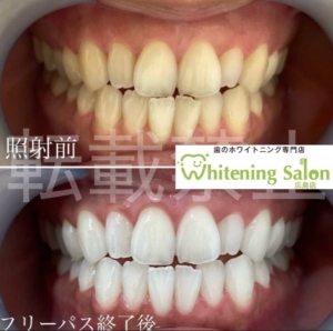 【歯の豆知識🦷🌟】広島/ホワイトニング