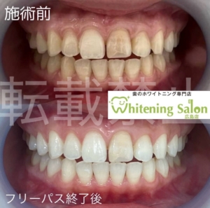 【歯と第一印象の関係 🦷✨】広島/ホワイトニング