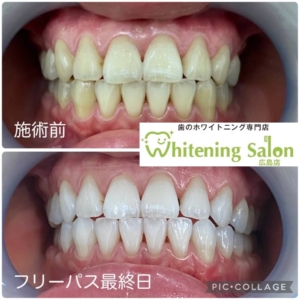 【ホワイトスポット⚡️】広島/ホワイトニング