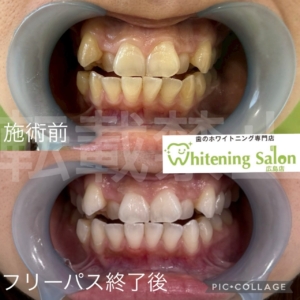 【歯ブラシの交換時期】広島/ホワイトニング