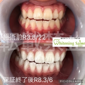 【口臭と健康状態】広島/ホワイトニング