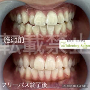 【お酒と口臭】広島/ホワイトニング