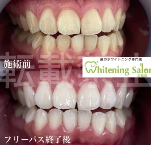 【歯が茶色い原因】広島/ホワイトニング