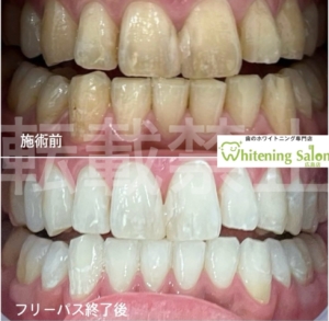 【ホワイトスポット📝】広島/ホワイトニング