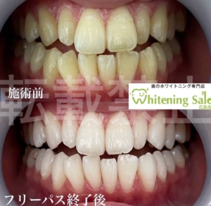 【歯肉炎と歯周病】広島/ホワイトニング