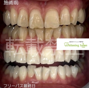 【歯の黄ばみや着色が気になる方】広島/ホワイトニング