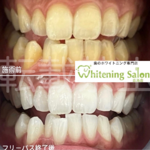 【8020運動🤲🏻】広島/ホワイトニング