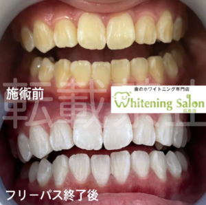 【春は歯がどうなる❓】広島/ホワイトニング