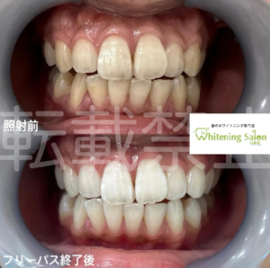 【赤ちゃんも虫歯に❓】広島/ホワイトニング