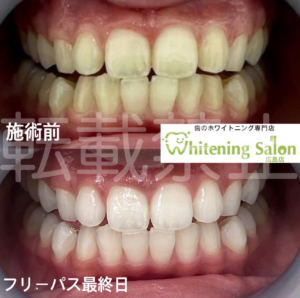 【黒ずみの原因】広島/ホワイトニング