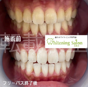 【歯周病の悪化】広島/ホワイトニング