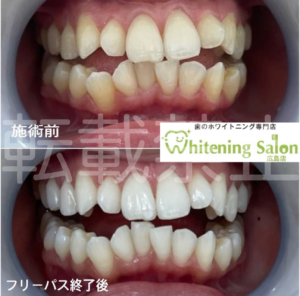 【噛む癖😣】広島/ホワイトニング